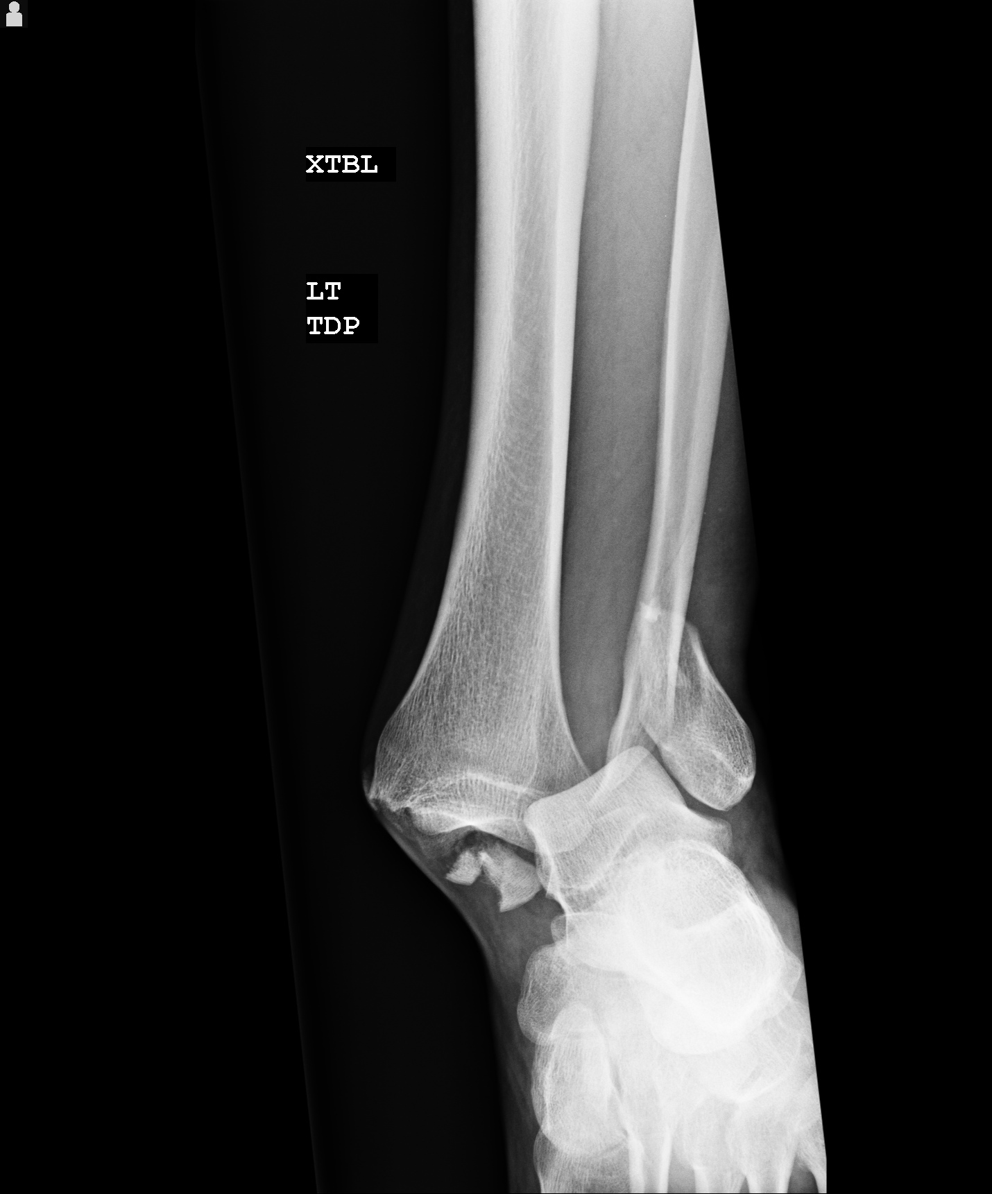 My Broken Leg part 1 Devon Hillard's Personal Blog